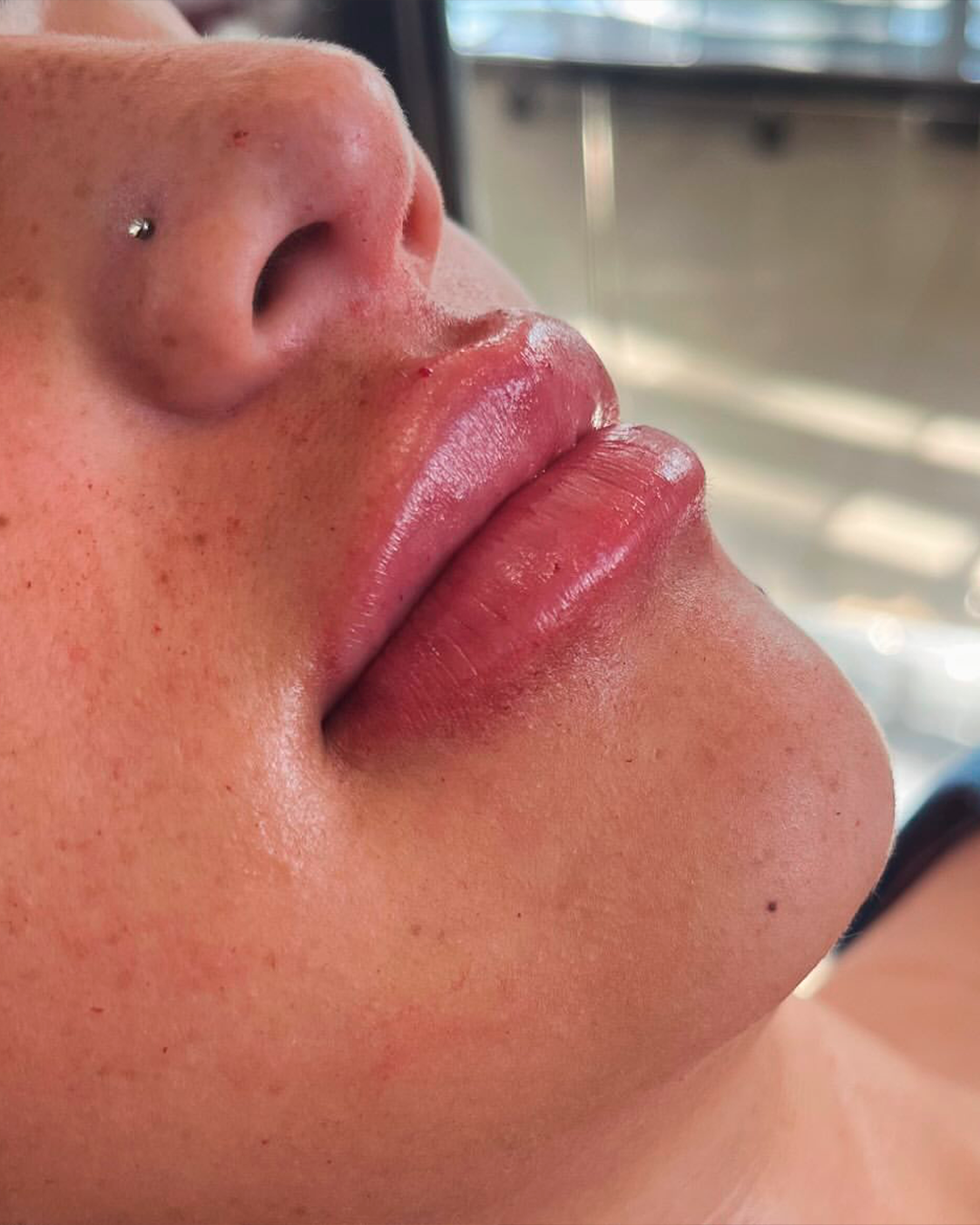Resultado de preenchimento labial