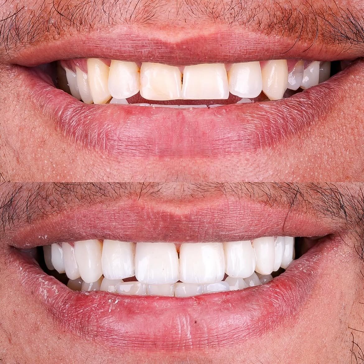 Resultado antes e depois de Facetas em Resina — Dra. Rita Fernanda
